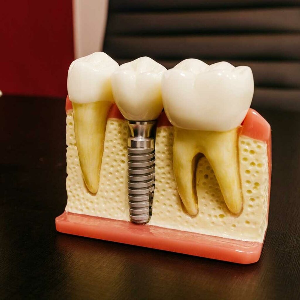 dogwood-dental-medspa-implants