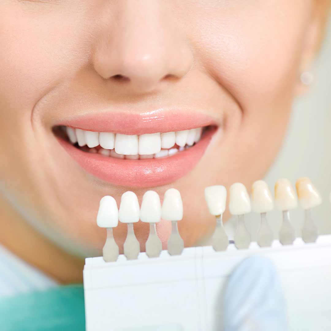 Teeth Whitening - Dogwood Dental Spa