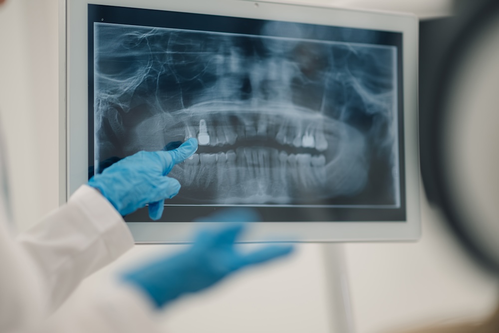 A dentist with blue gloves on pointing at a patient's x-ray of their teeth after their dental cleaning near Waxhaw.
