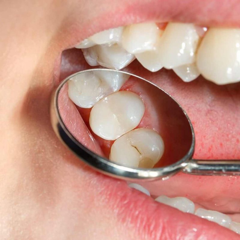 dogwood-dental-medspa-clear-sealants-2