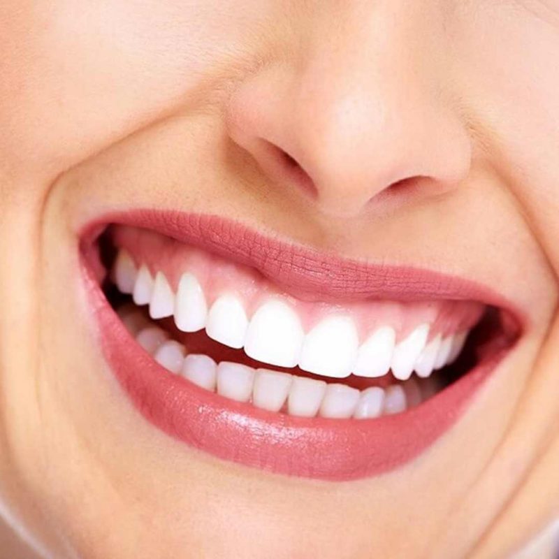 dogwood-dental-medspa-teeth-fillings3